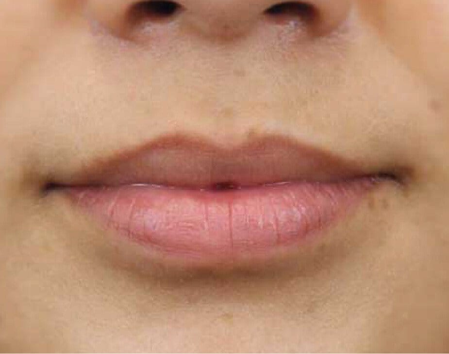 Dermal Fillers