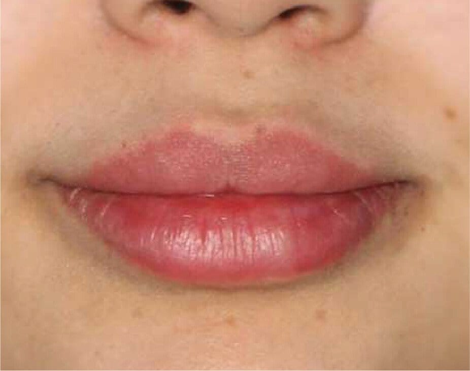 Dermal Fillers