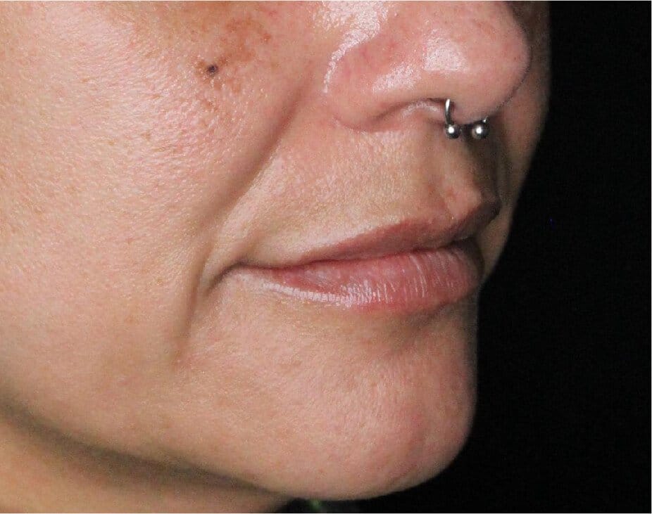Dermal Fillers