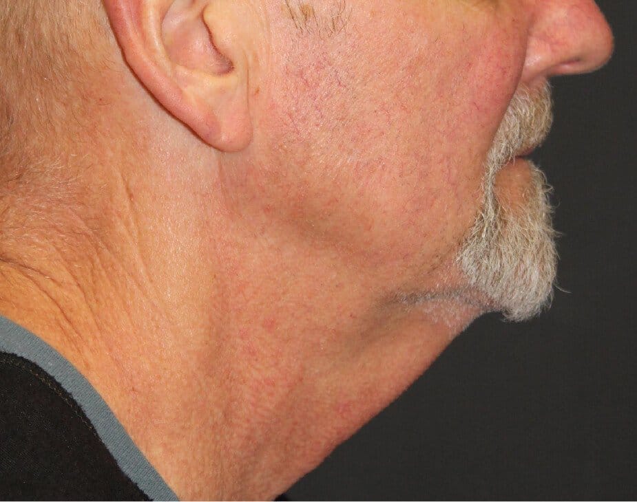 Facelift & Neck Lift
