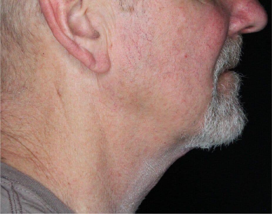 Facelift & Neck Lift