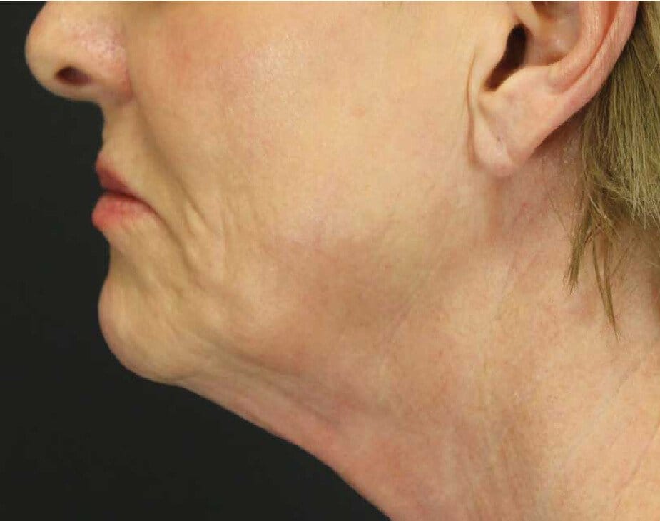 Facelift & Neck Lift