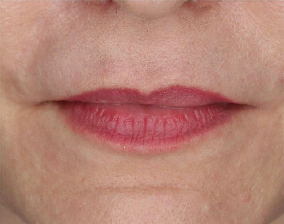 Lip Lift