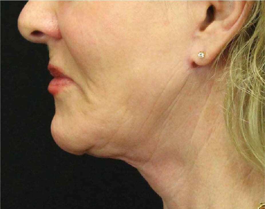 Facelift & Neck Lift
