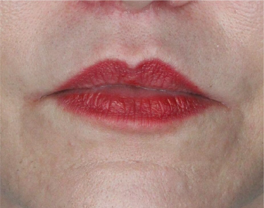 Lip Lift