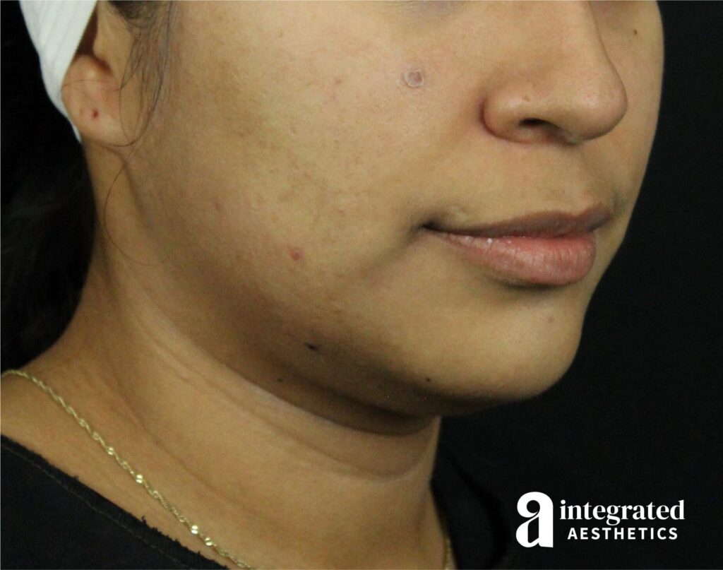 Lip Lift
