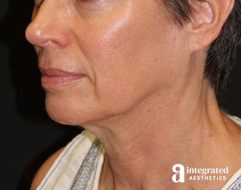 Facelift & Neck Lift