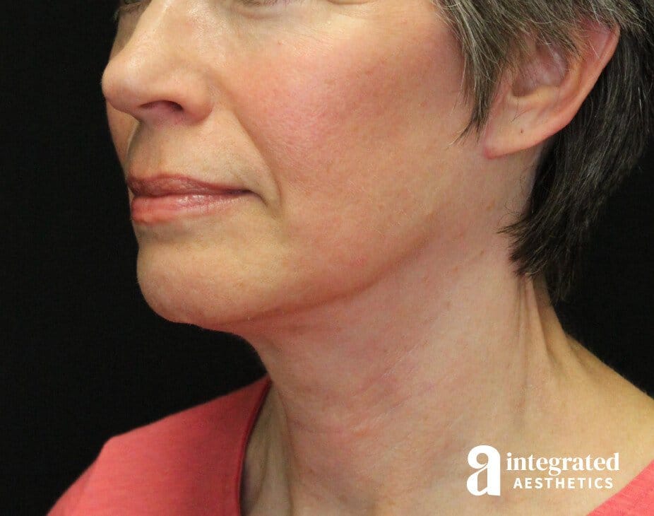 Facelift & Neck Lift