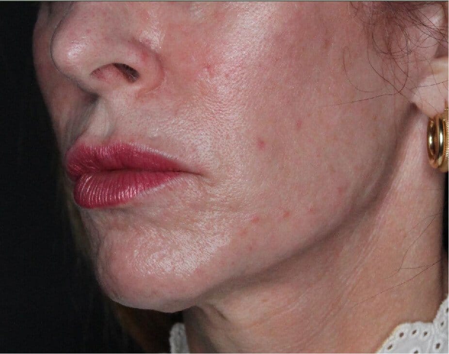 Sculptra