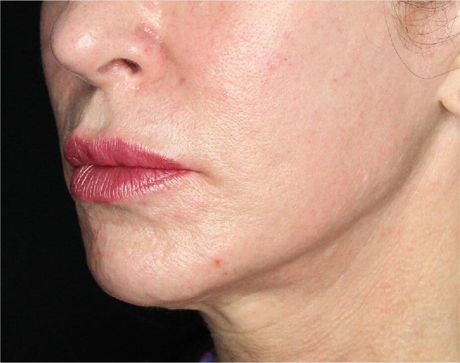 Sculptra