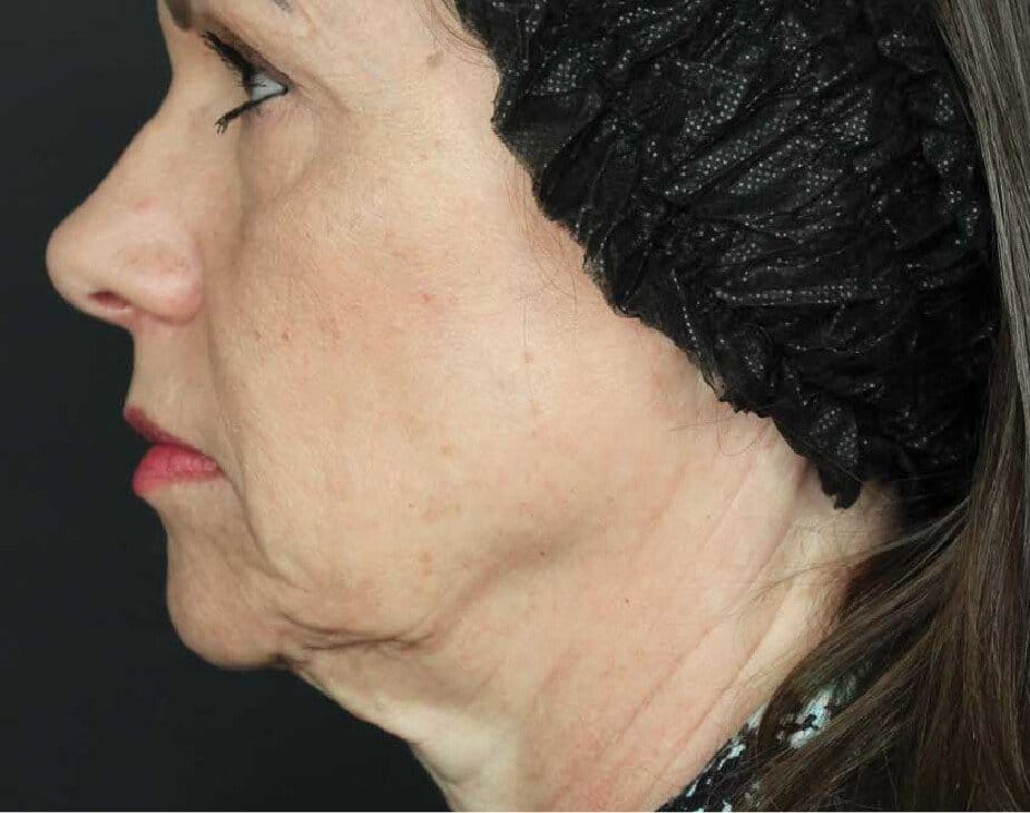 Sculptra