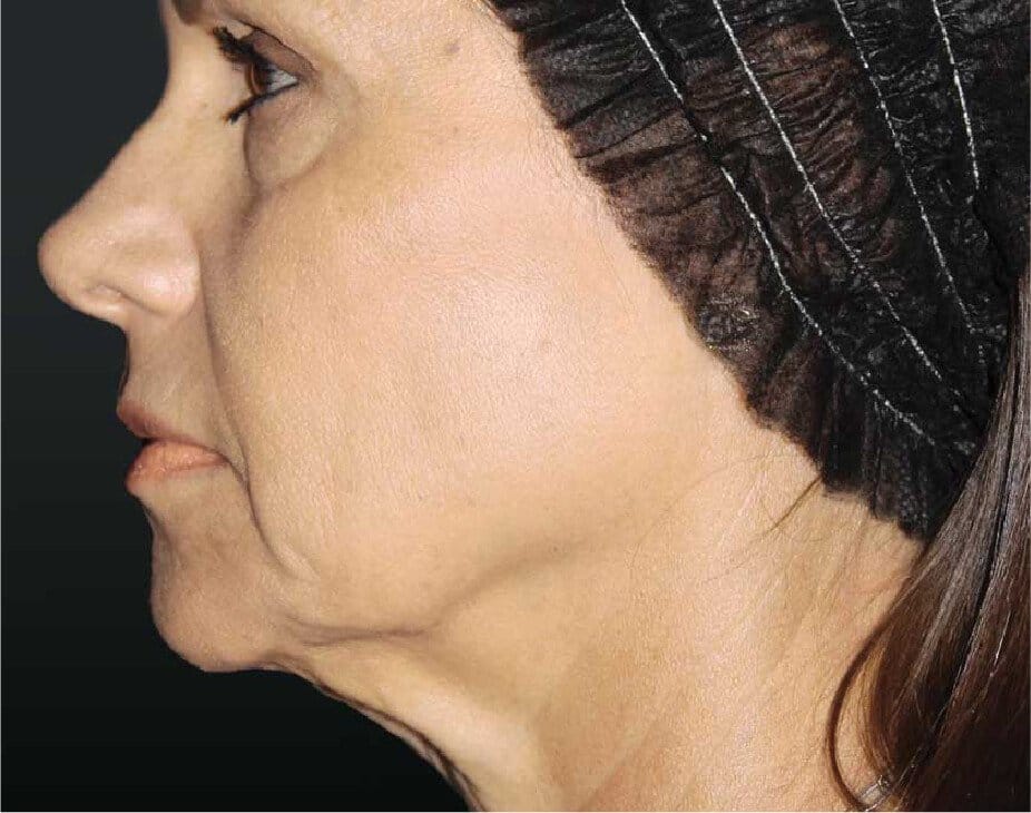 Sculptra