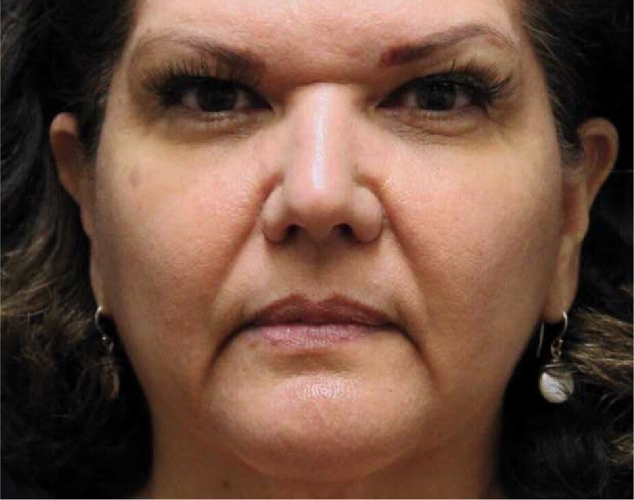 Wrinkle Relaxers