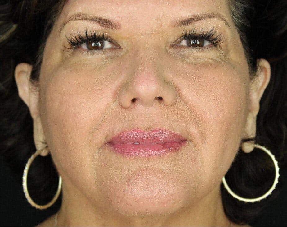 Wrinkle Relaxers