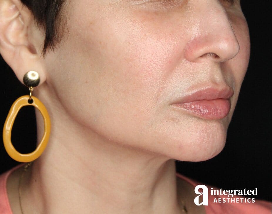 FaceTite & AccuTite