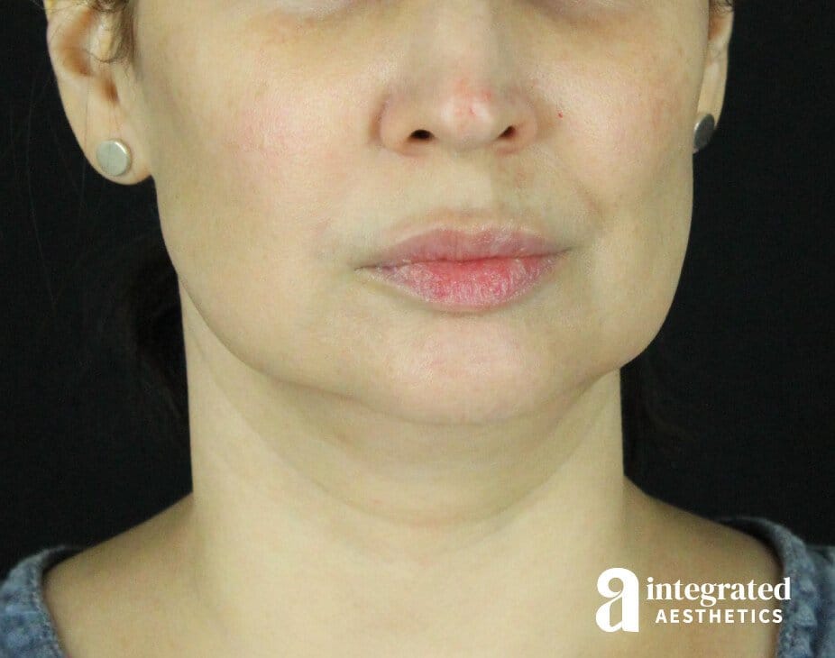 Dermal Fillers