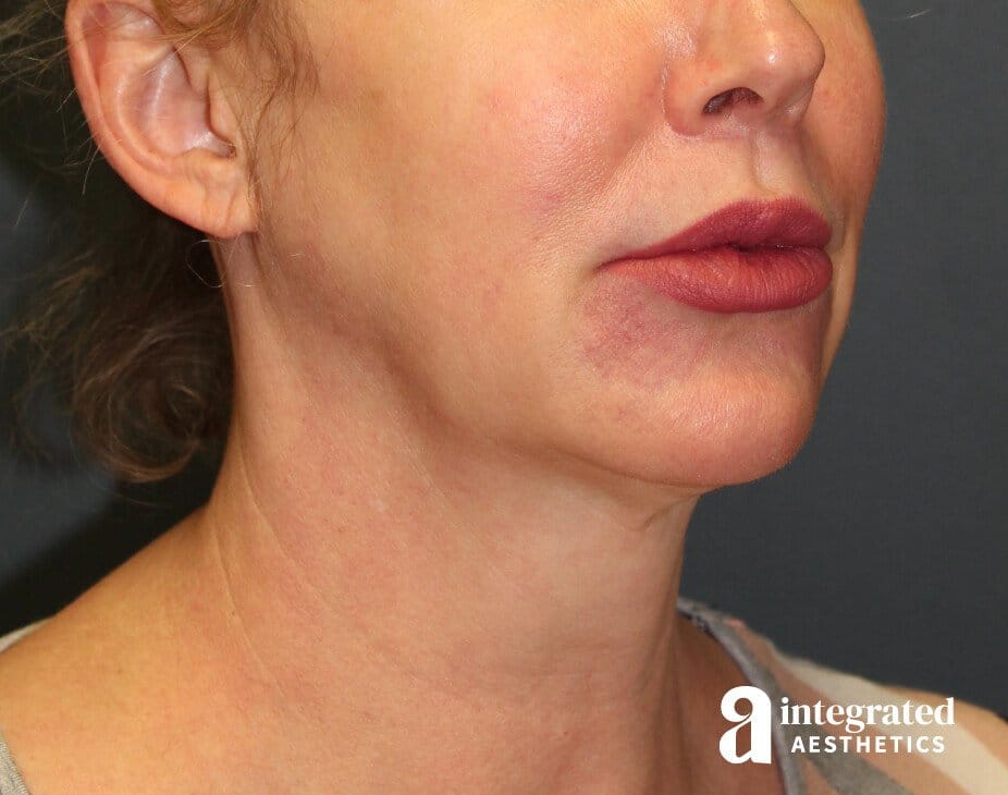 FaceTite & AccuTite