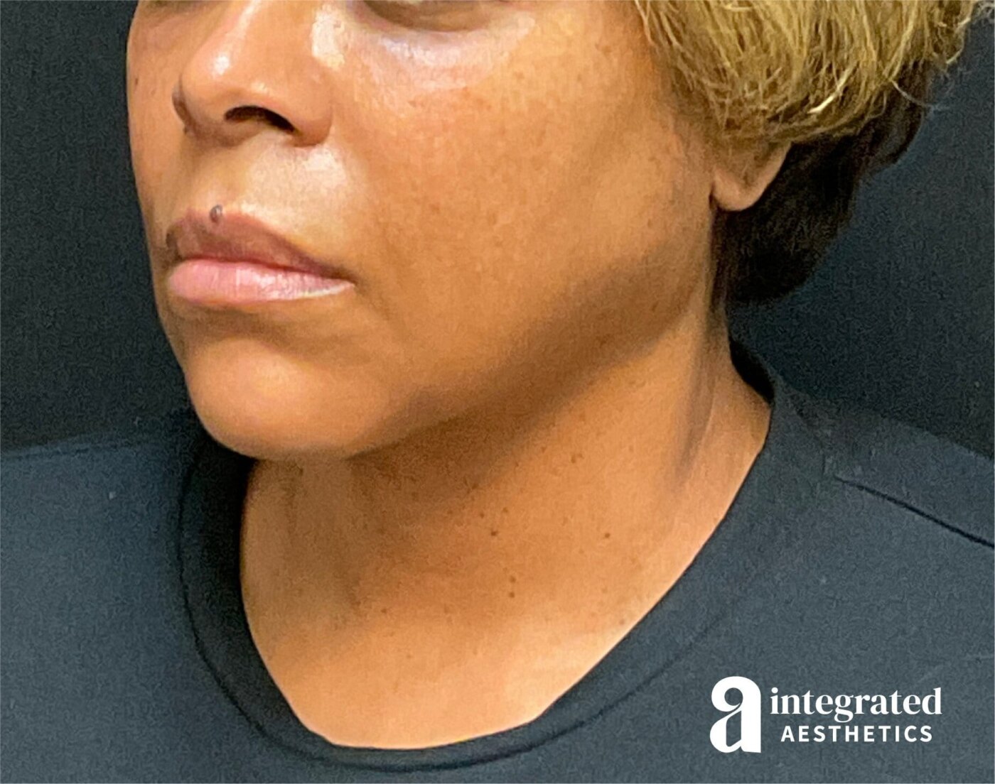 FaceTite & AccuTite