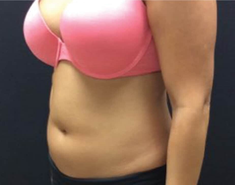 CoolSculpting