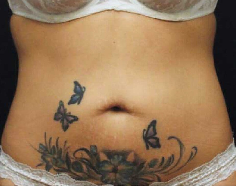 CoolSculpting