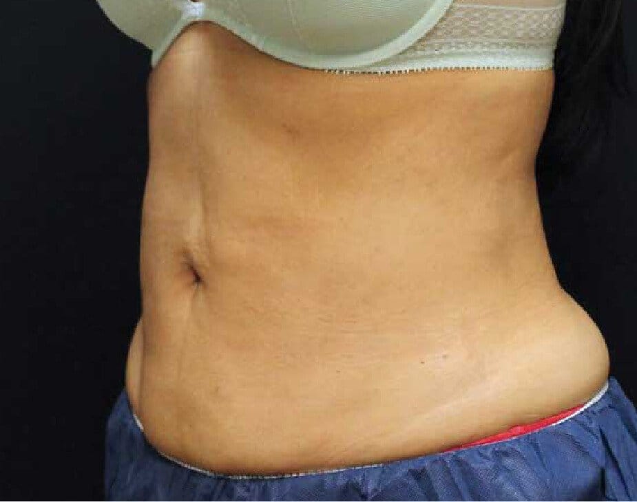 EmSculpt