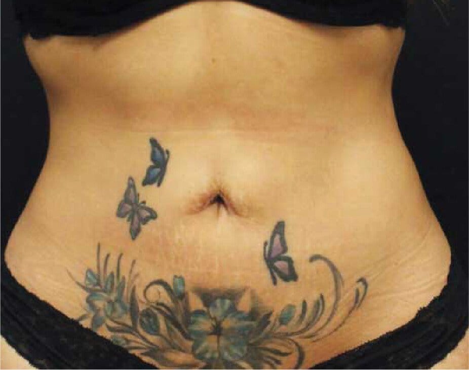 CoolSculpting