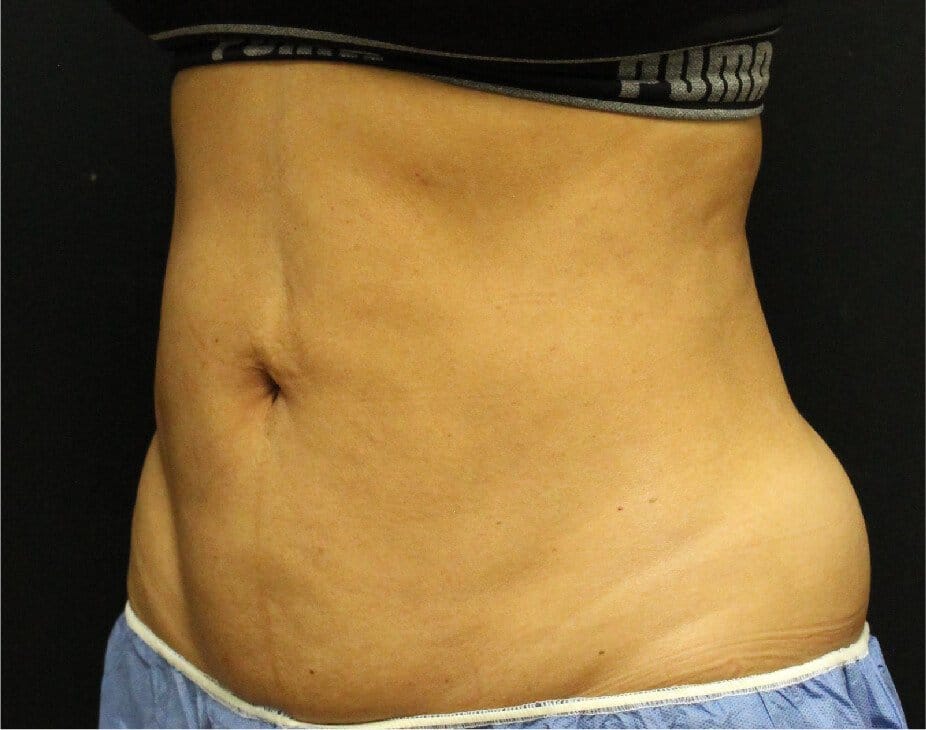 EmSculpt