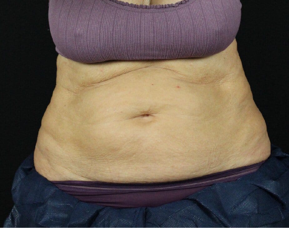 EmSculpt