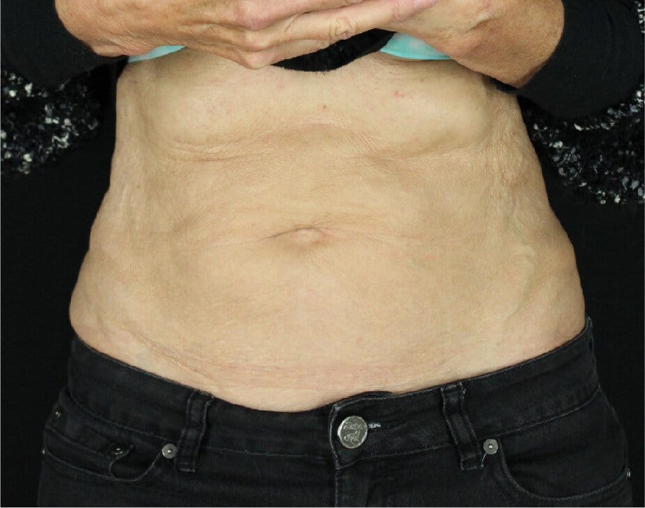 EmSculpt