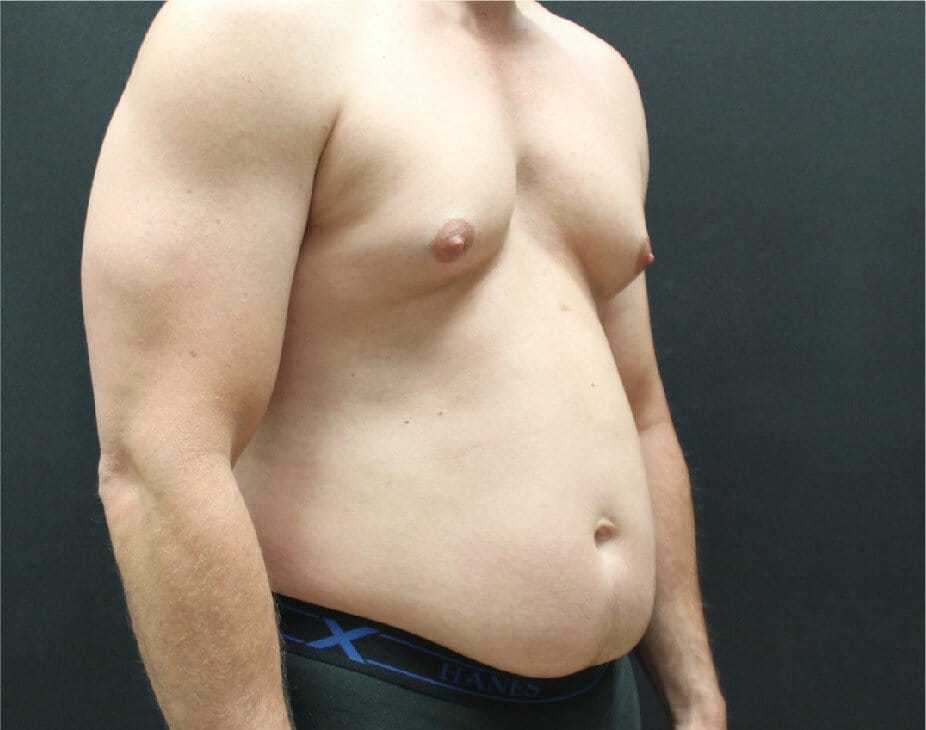 Liposuction