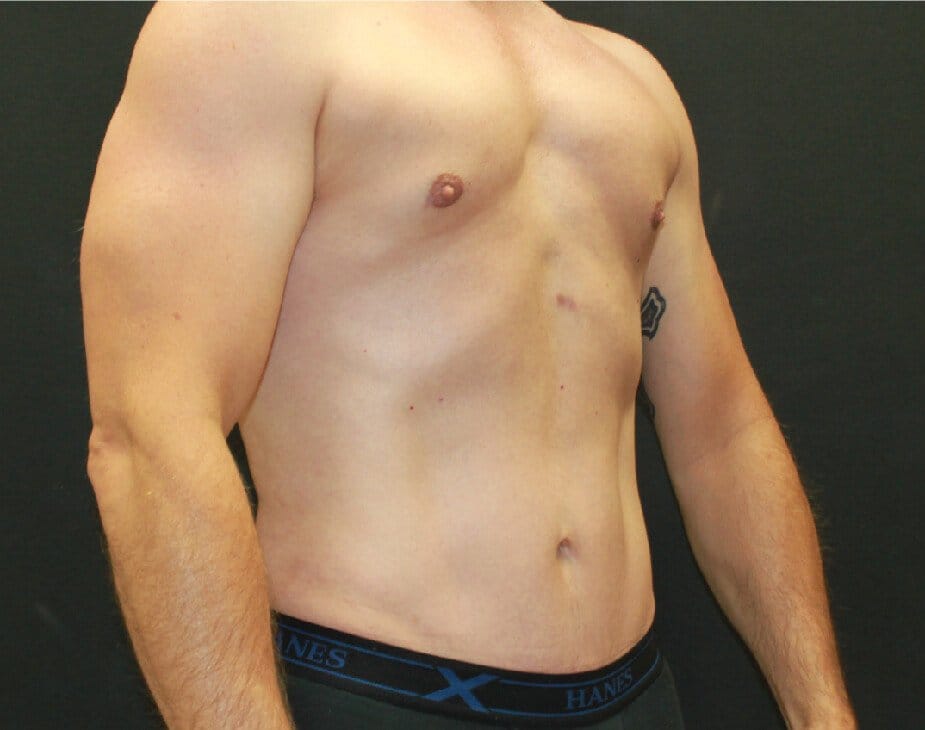 Liposuction