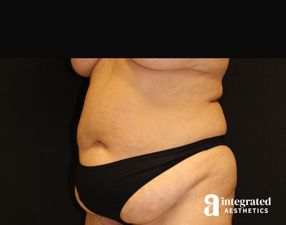 Tummy Tuck