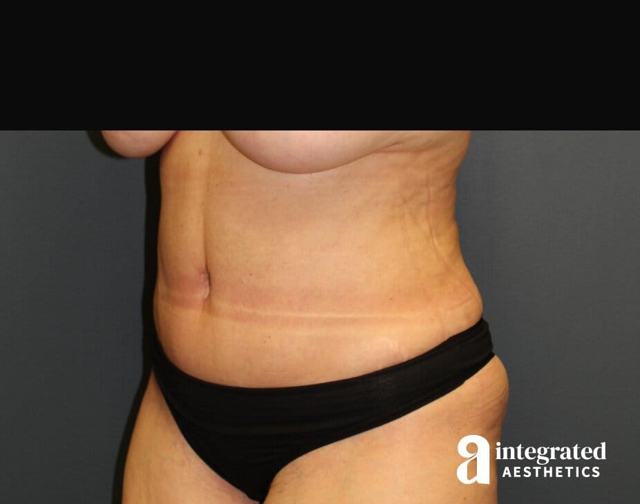 Tummy Tuck