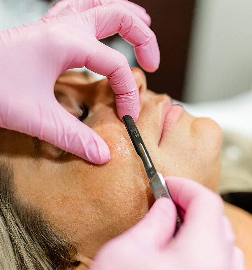 woman getting dermaplaning done