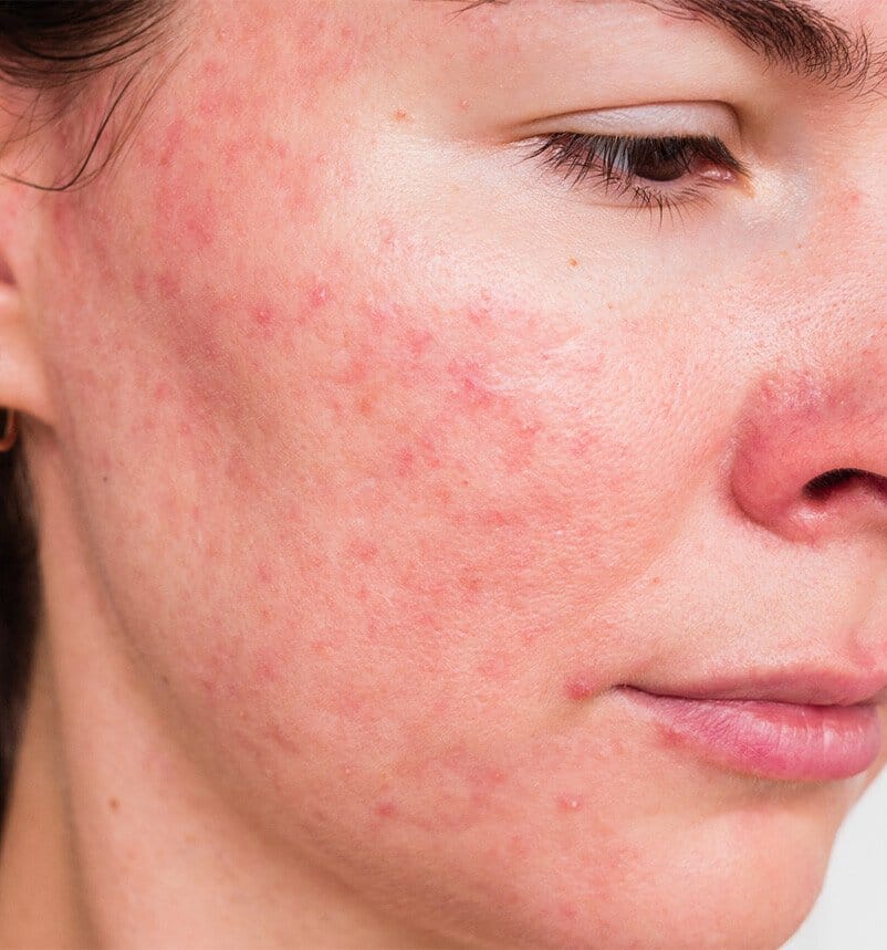 woman with rosacea