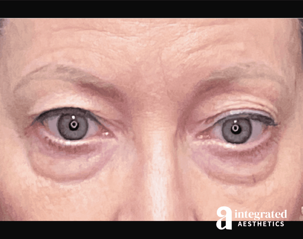 Blepharoplasty