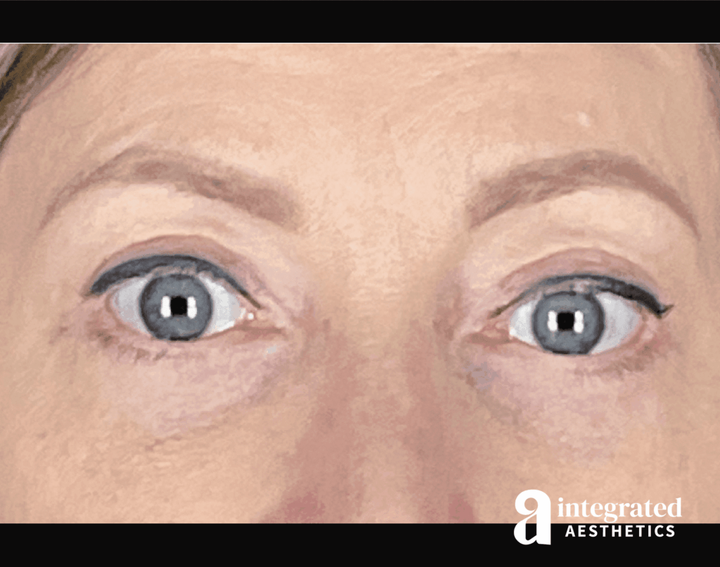 Blepharoplasty