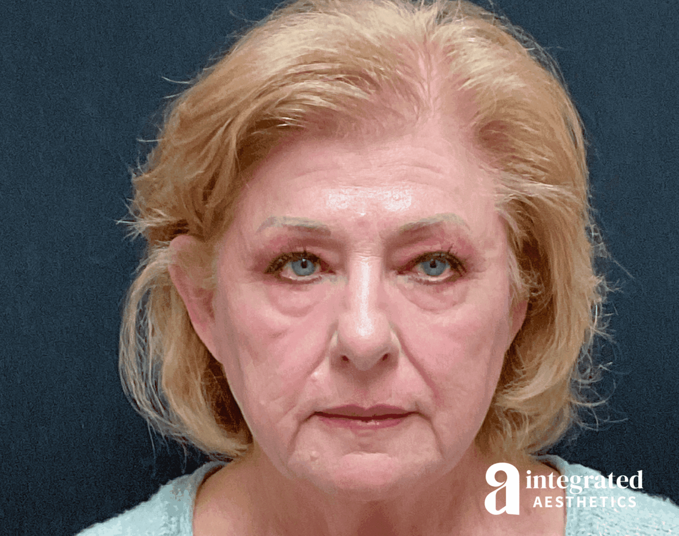 Blepharoplasty