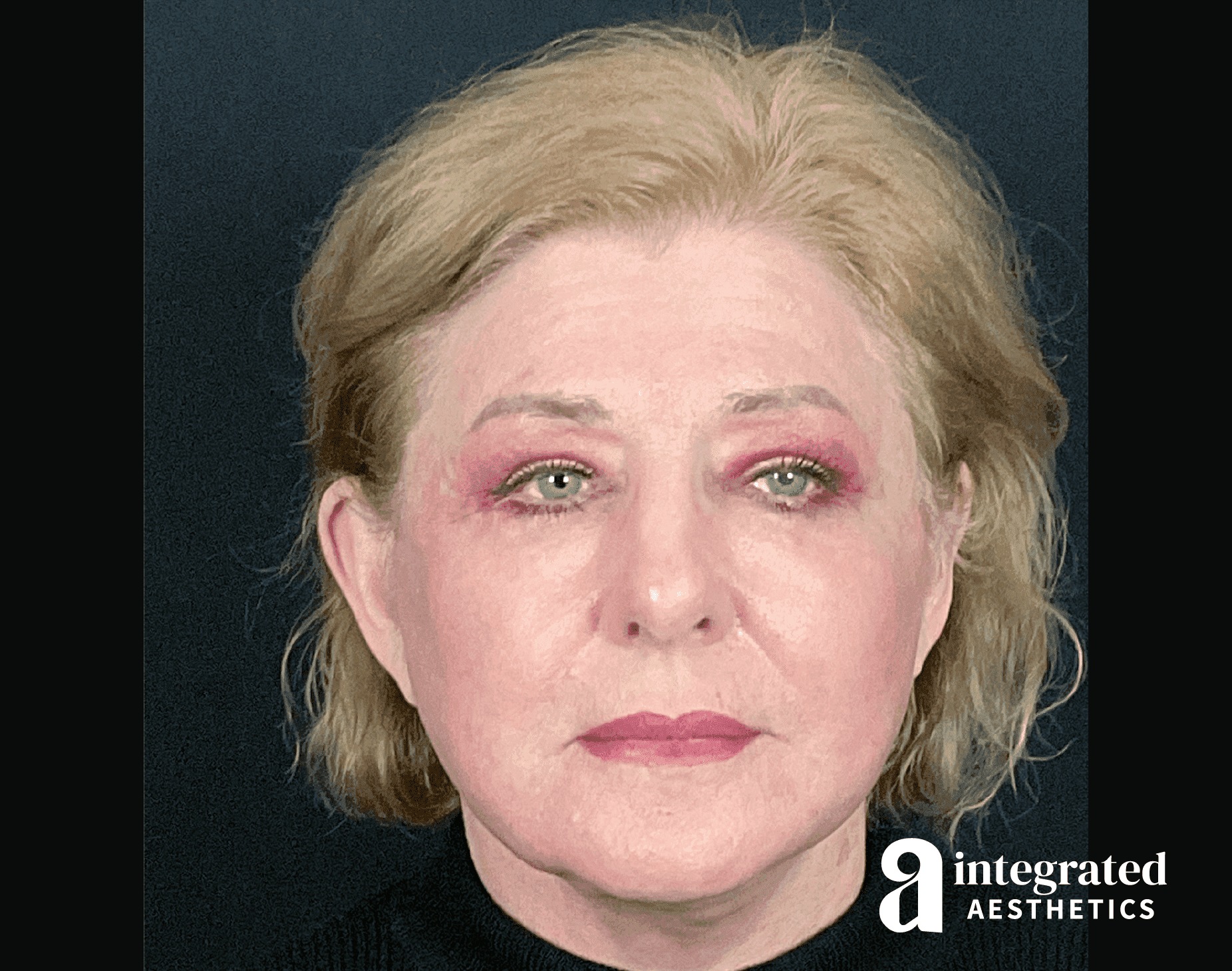 Blepharoplasty