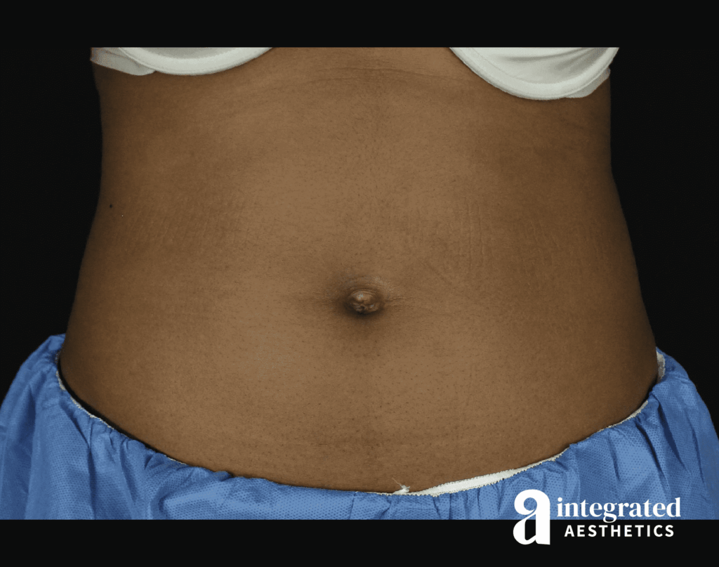 CoolSculpting