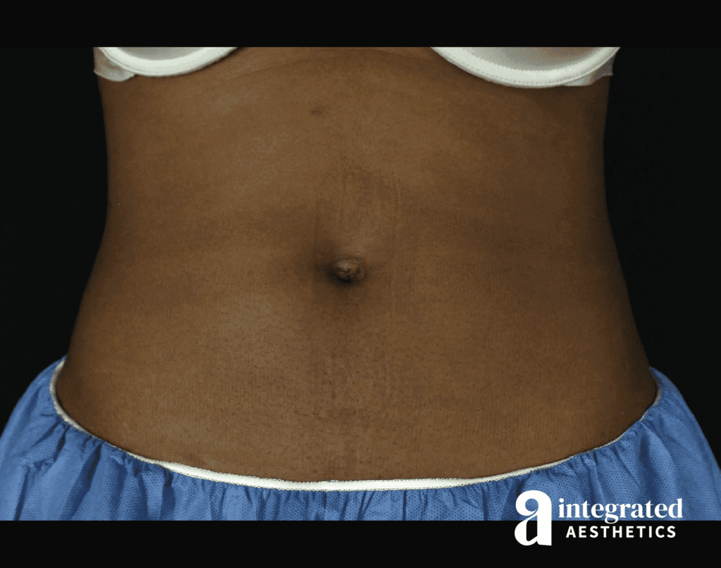 CoolSculpting