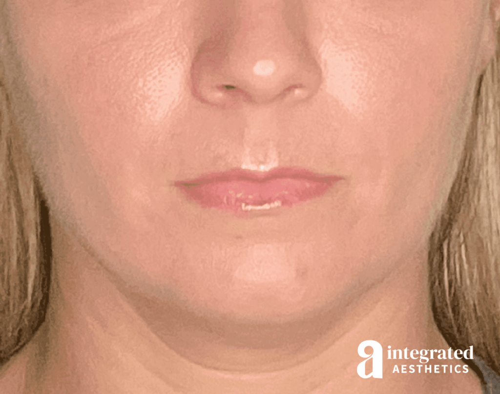 Dermal Fillers