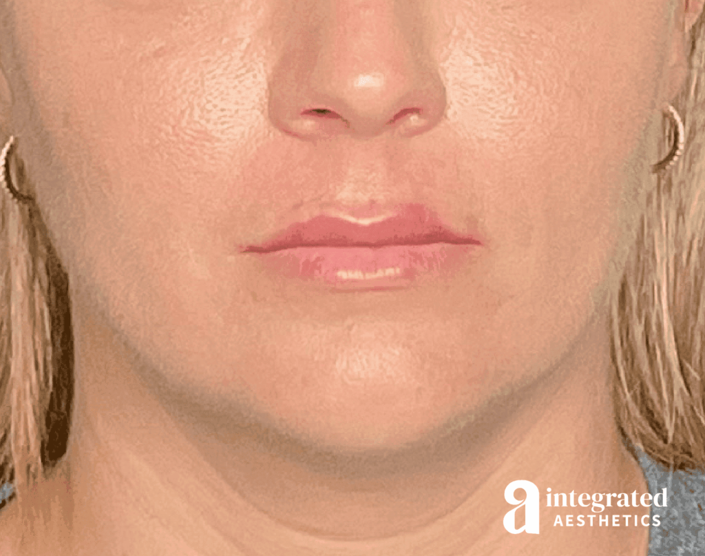 Lip Filler