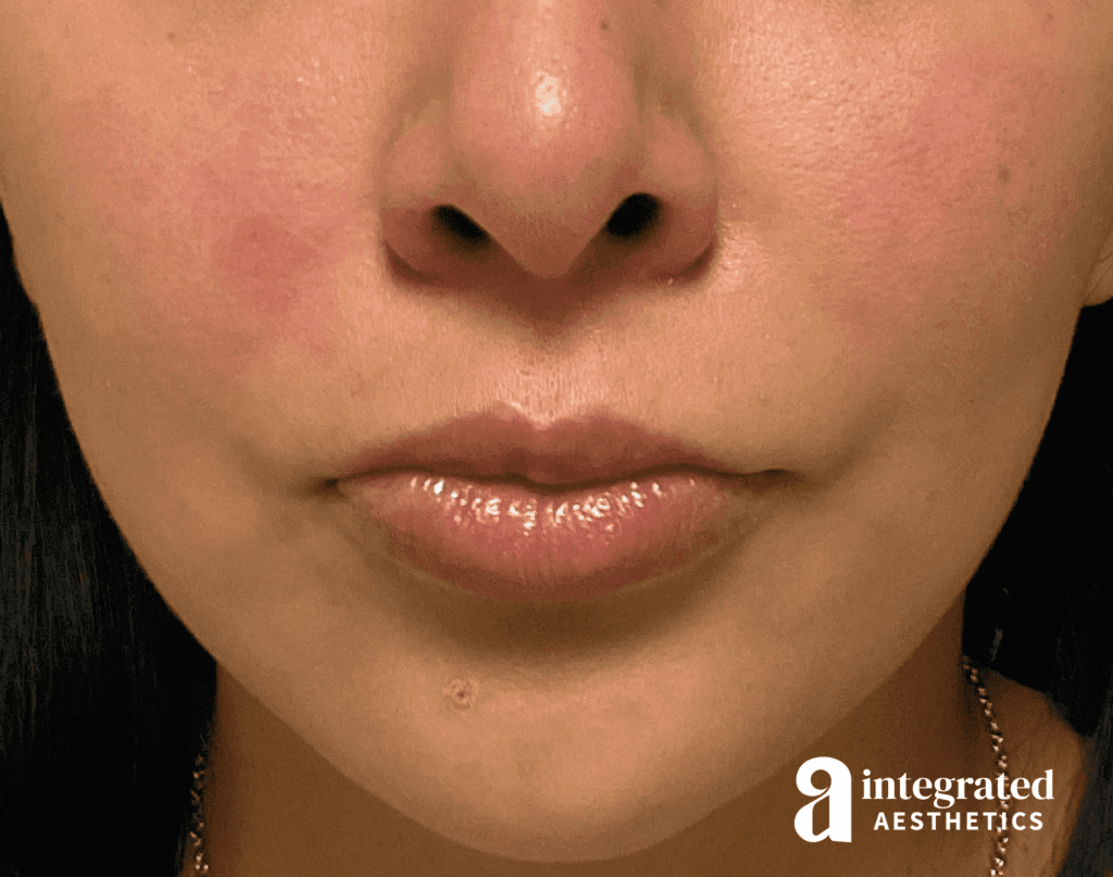 Resolved Aesthetic Complications