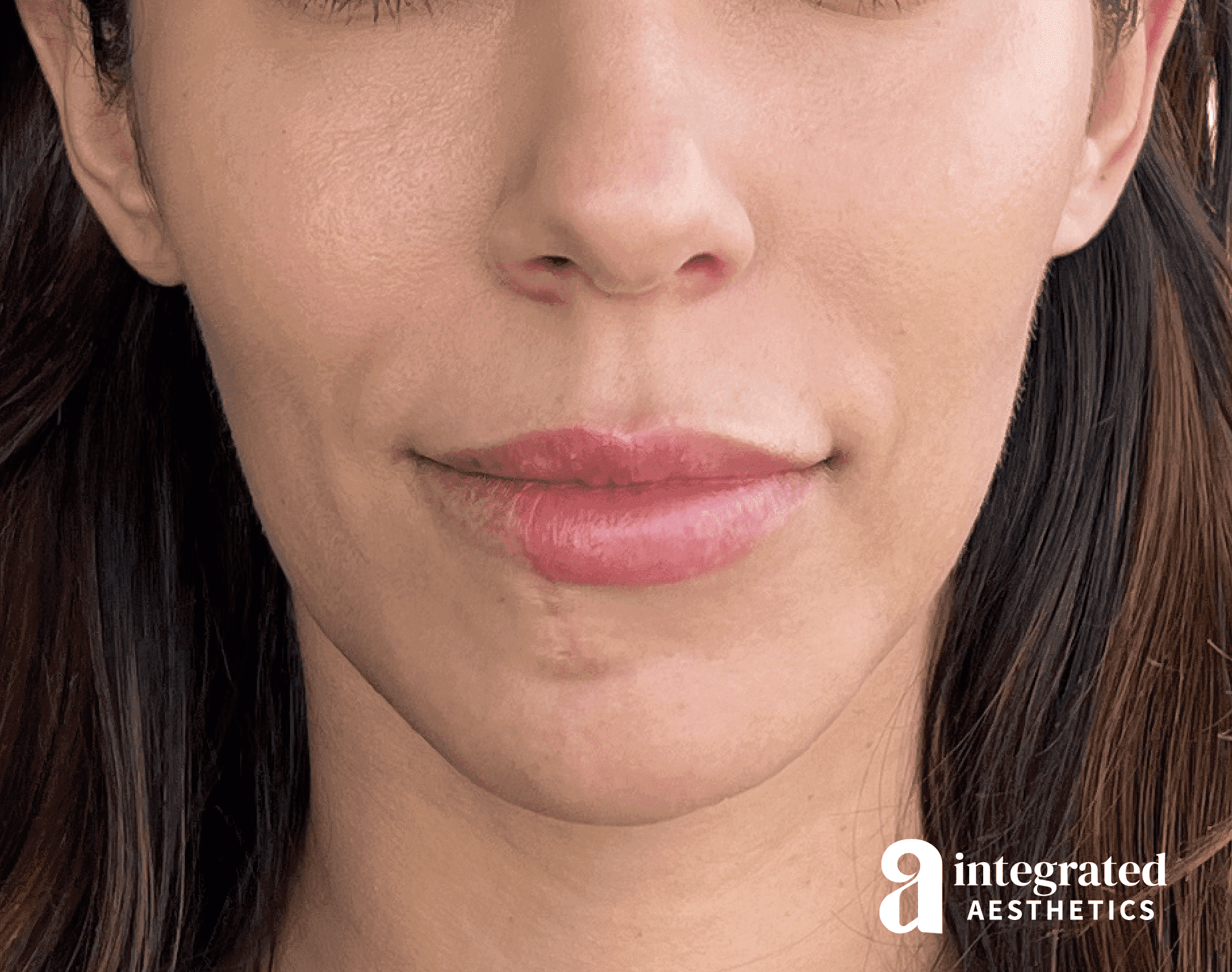 Dermal Fillers