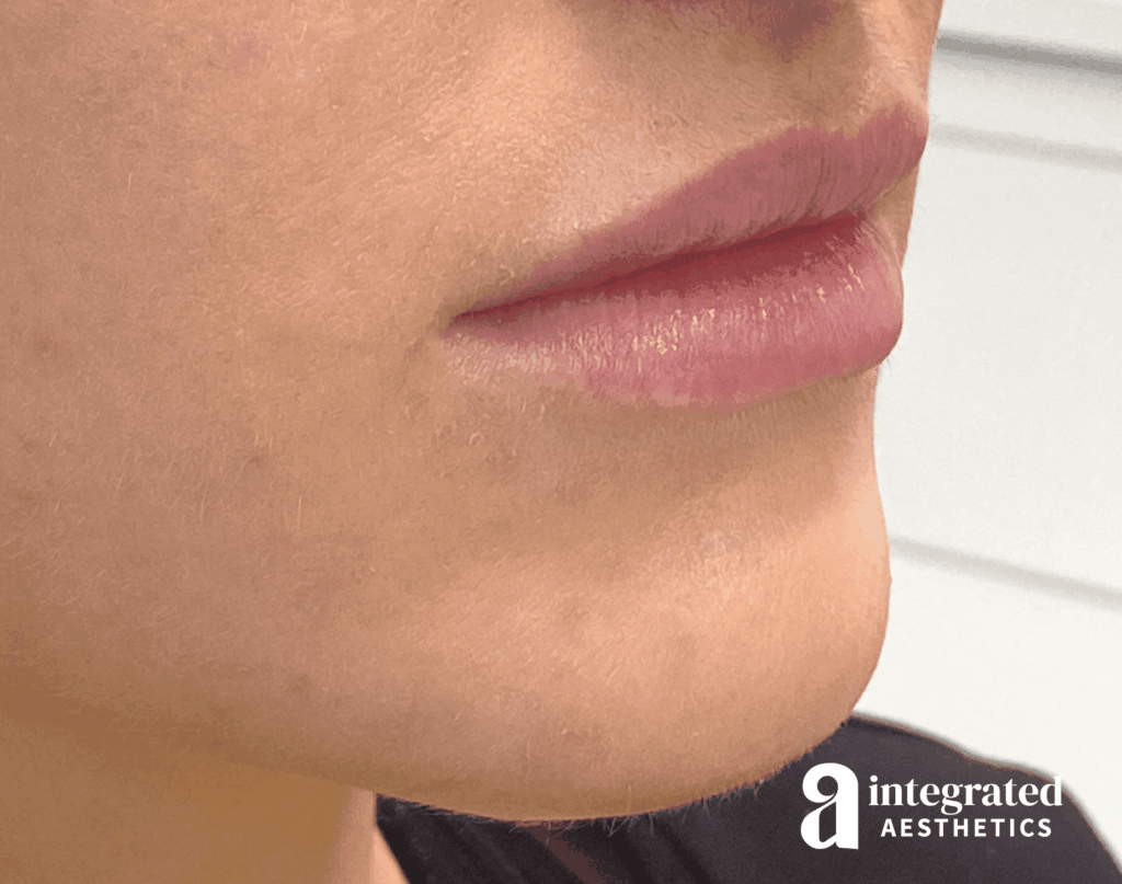 Dermal Fillers