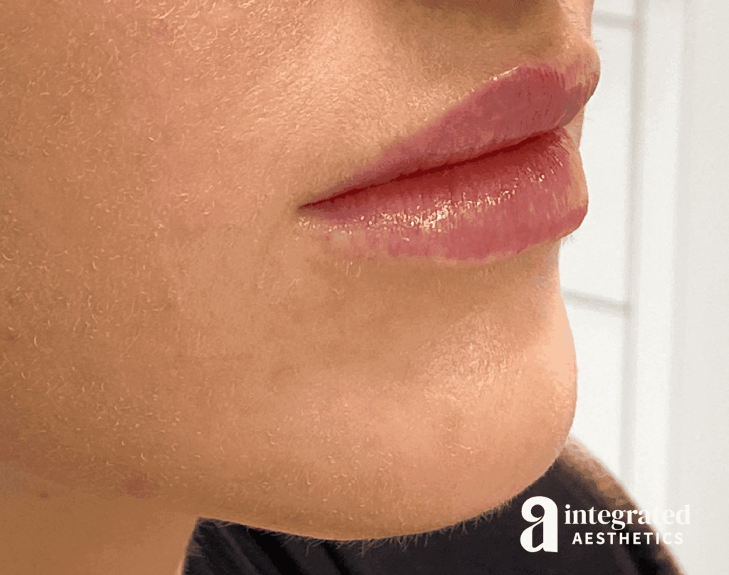 Dermal Fillers