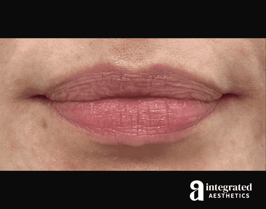 Dermal Fillers