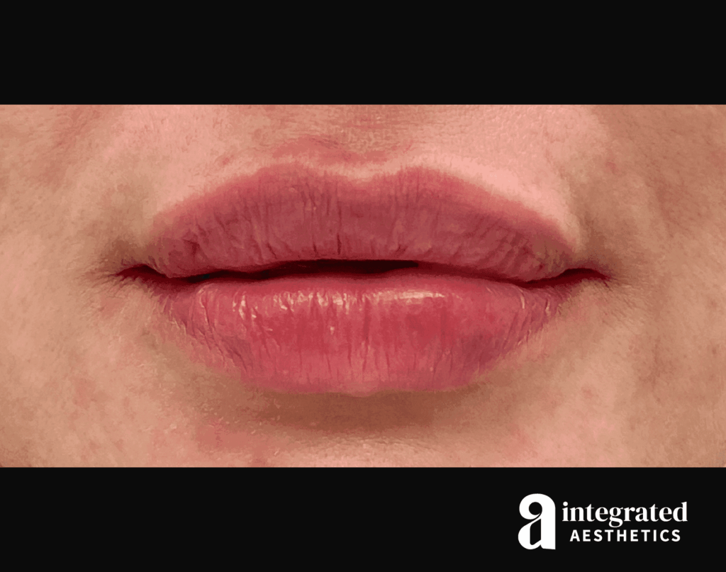 Lip Filler