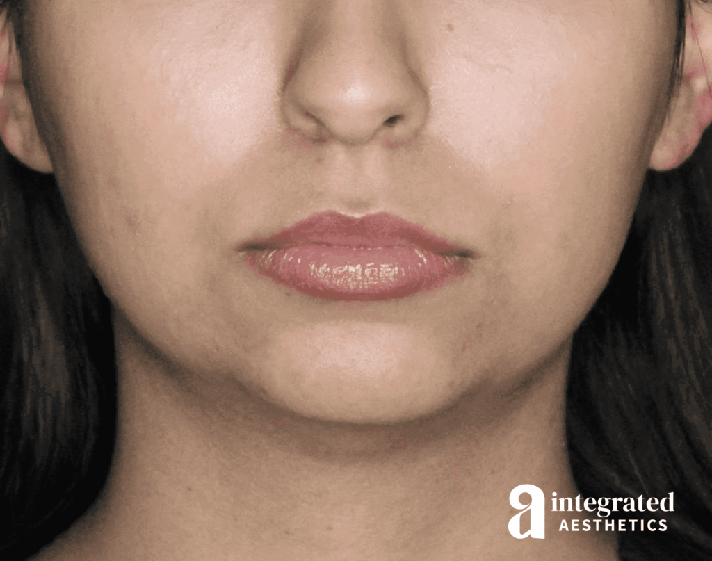 Dermal Fillers